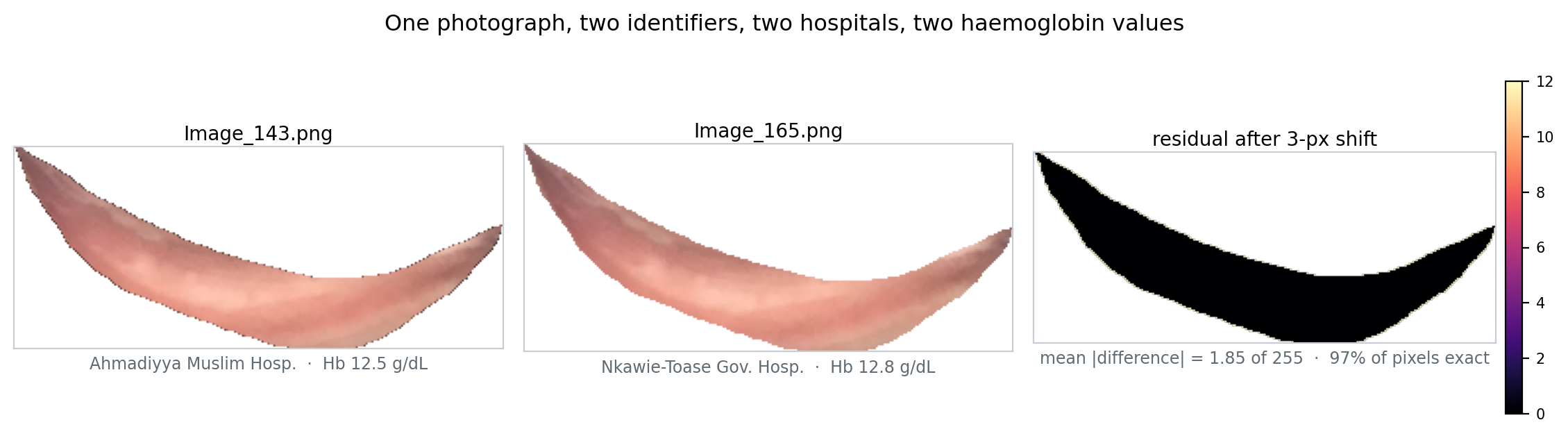 Figure from the preprint: the same conjunctiva photograph filed under two identifiers at two hospitals with two haemoglobin values, and the near-zero residual after a 3-pixel shift